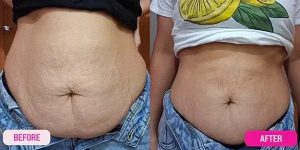 Barriga com estrias