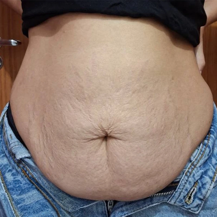 Abdomen más tonificado sin cirugía