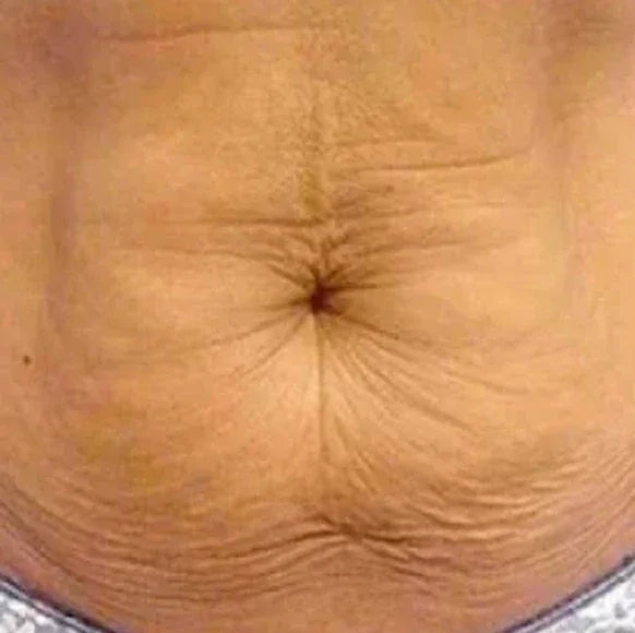 Piel más firme, menos flacidez