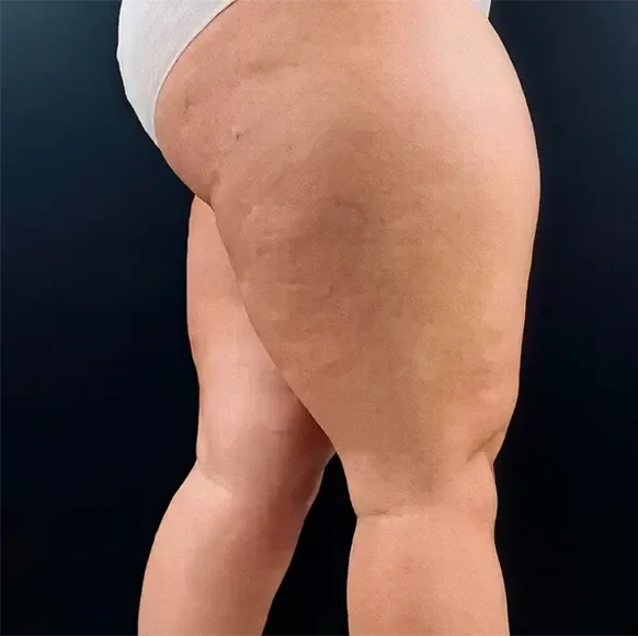 Celulitis visiblemente reducida