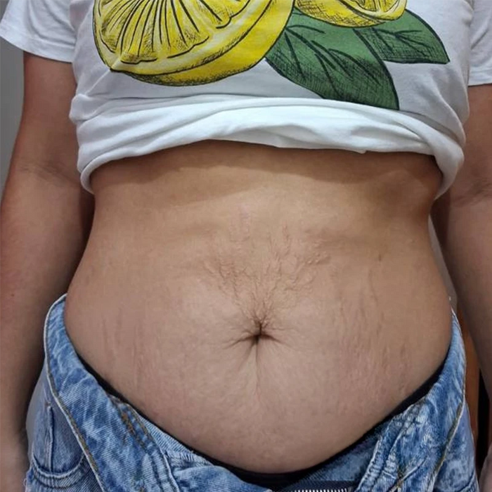 Abdomen más tonificado sin cirugía